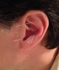 L’acupuncture auriculaire traite avec succès le surpoids.